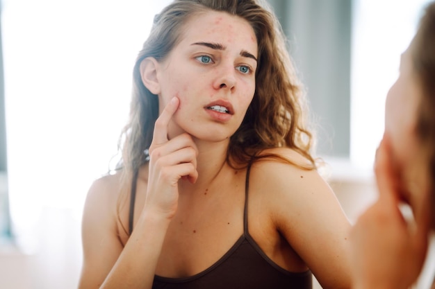 Twarz naczynkowa objawy jak je rozpoznać?