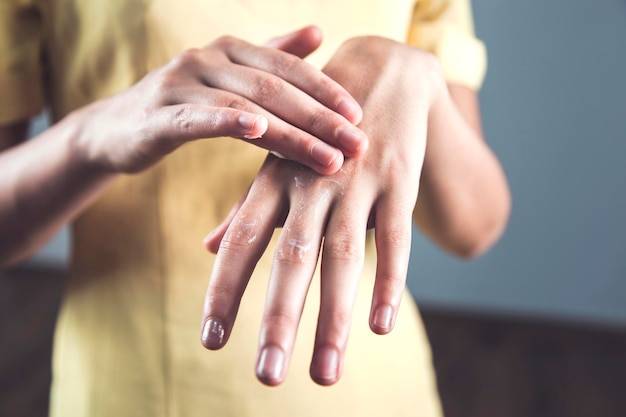 Co jest przyczyną pękania skóry na dłoniach?