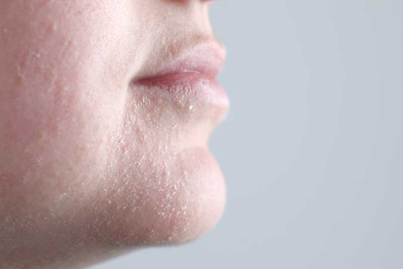 Odwodniona skóra twarzy czy brak sebum?